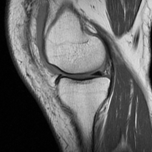 File:Non-displaced patella fracture (Radiopaedia 15932-15582 Sagittal T1 6).jpg