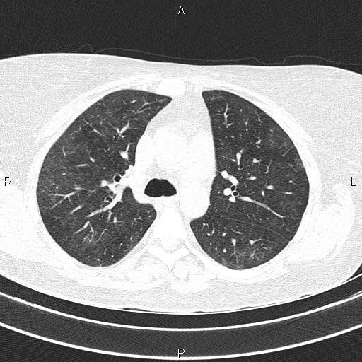 Non-specific interstitial pneumonia (Radiopaedia 83185-97567 Axial lung window 26).jpg