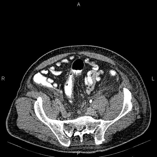 Non Hodgkin lymphoma in a patient with ankylosing spondylitis (Radiopaedia 84323-99621 Axial C+ delayed 60).jpg