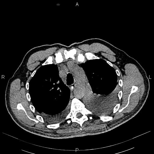 File:Non Hodgkin lymphoma in a patient with ankylosing spondylitis (Radiopaedia 84323-99621 Axial non-contrast 9).jpg