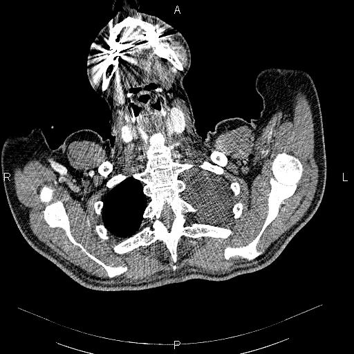 File:Non Hodgkin lymphoma in a patient with ankylosing spondylitis (Radiopaedia 84323-99621 B 4).jpg