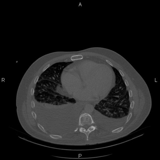 Non Hodgkin lymphoma in a patient with ankylosing spondylitis (Radiopaedia 84323-99624 Axial bone window 20).jpg