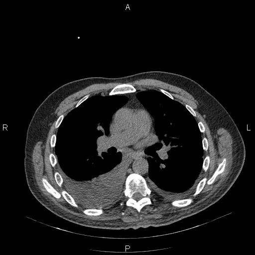 File:Non Hodgkin lymphoma in a patient with ankylosing spondylitis (Radiopaedia 84323-99624 Axial non-contrast 17).jpg