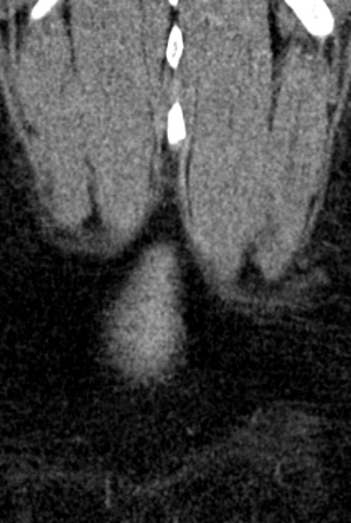 Normal CT lumbar spine (Radiopaedia 53981-60118 F 104).jpg