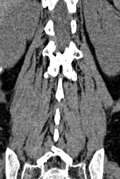 Normal CT lumbar spine (Radiopaedia 53981-60118 F 72).jpg