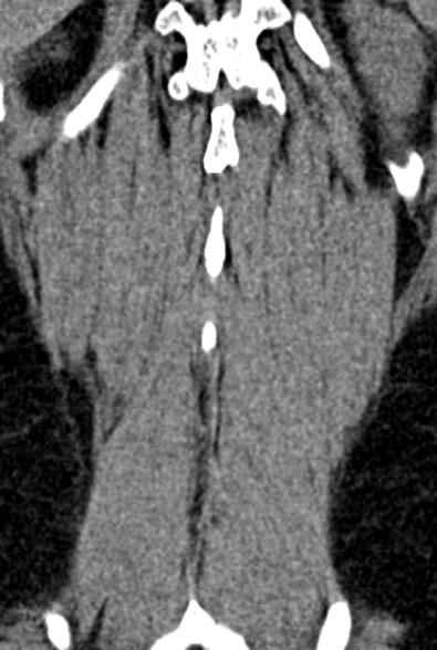 Normal CT lumbar spine (Radiopaedia 53981-60118 F 90).jpg