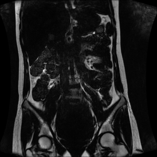 Normal MRI abdomen in pregnancy (Radiopaedia 88001-104541 N 73).jpg