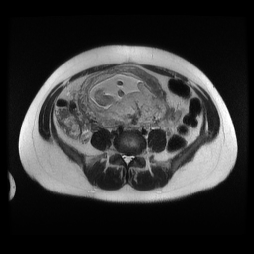 Normal MRI abdomen in pregnancy (Radiopaedia 88003-104546 Axial T2 26).jpg