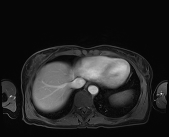 Normal adrenal glands MRI (Radiopaedia 82017-96004 K 9).jpg