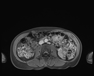 Normal adrenal glands MRI (Radiopaedia 82017-96004 M 55).jpg