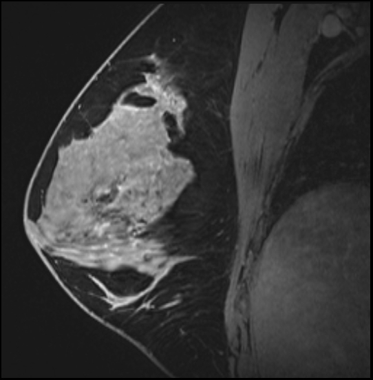 Normal breast MRI - dense breasts (Radiopaedia 80454-93850 I 91).jpg
