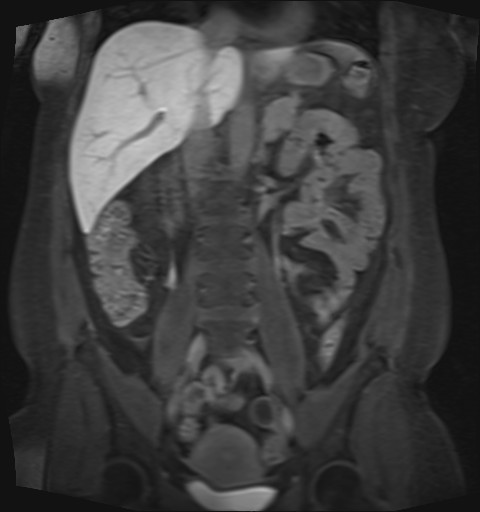 File:Normal hepatobiliary phase liver MRI (Radiopaedia 58968-66230 B 25).jpg