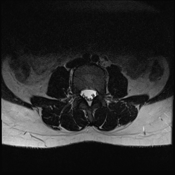 File:Normal lumbar spine MRI- 3 T (Radiopaedia 53280-59250 Axial T2 11).jpg