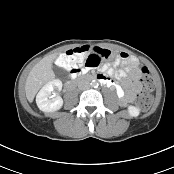 File:Normal multiphase CT liver (Radiopaedia 38026-39996 C 46).jpg