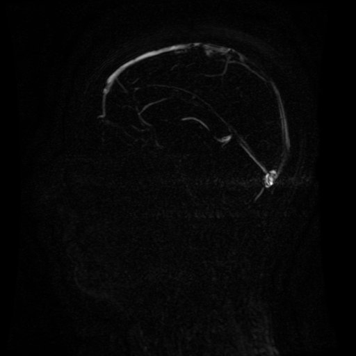 Normal noncontrast MR venography (Radiopaedia 87578-103957 A 86).jpg