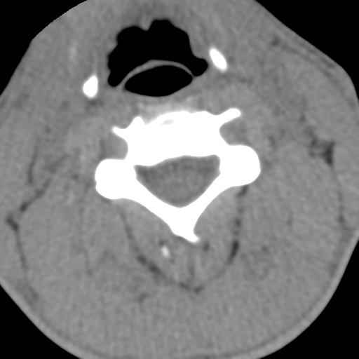 Normal trauma cervical spine (Radiopaedia 41017-43760 Axial non-contrast 28).png