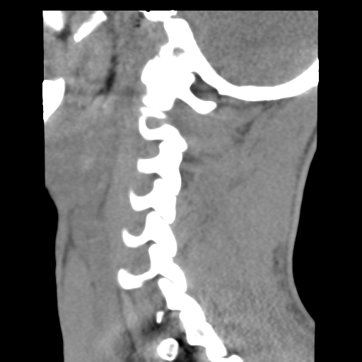 File:Normal trauma cervical spine (Radiopaedia 41017-43760 B 22).png