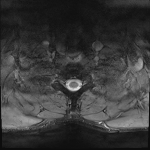 File:Normal trauma cervical spine (Radiopaedia 41017-43762 Axial T2 28).png