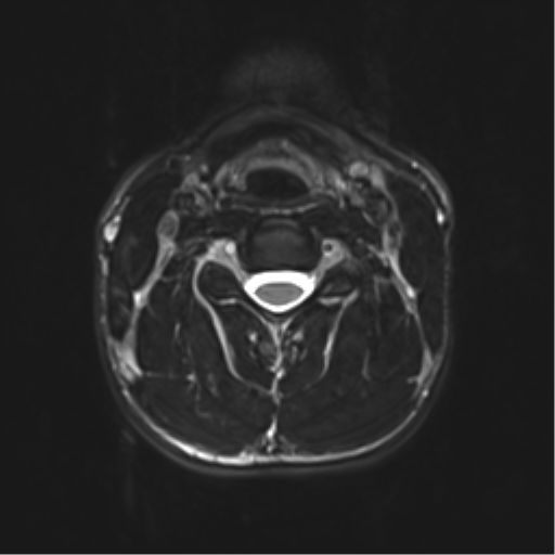 Normal trauma cervical spine (Radiopaedia 41017-43762 D 22).png