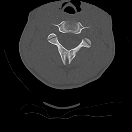 Normal trauma spine imaging (age 16) (Radiopaedia 45335-49358 Axial bone window 26).jpg