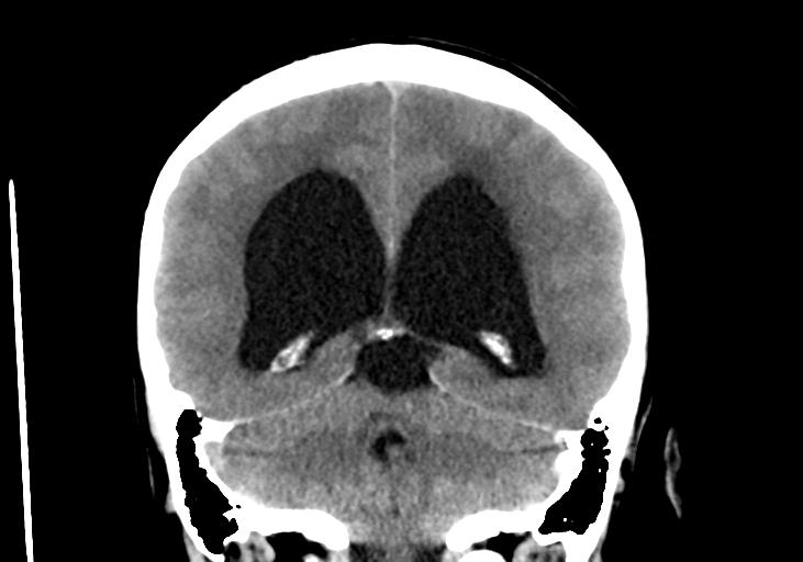 File:Obstructive hydrocephalus (Radiopaedia 30453-31119 Coronal non-contrast 26).jpg