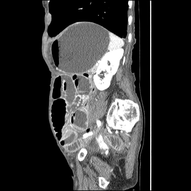 Obturator hernia causing small bowel obstruction (Radiopaedia 65522-74612 C 27).jpg