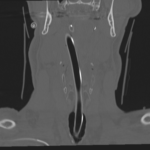 File:Occipital condyle fracture (Radiopaedia 33467-34517 Coronal bone window 5).png