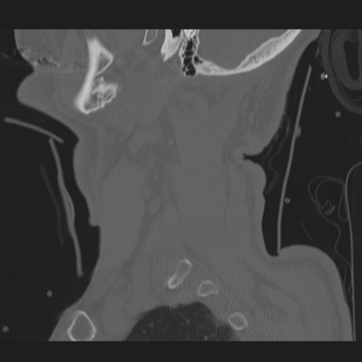 File:Occipital condyle fracture (Radiopaedia 33467-34517 Sagittal bone window 5).png