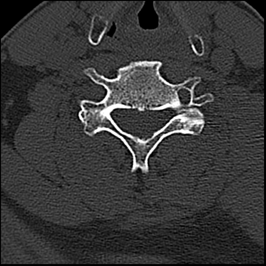 Occipital condyle fracture (type 1) (Radiopaedia 87670-104084 Axial bone window 58).jpg