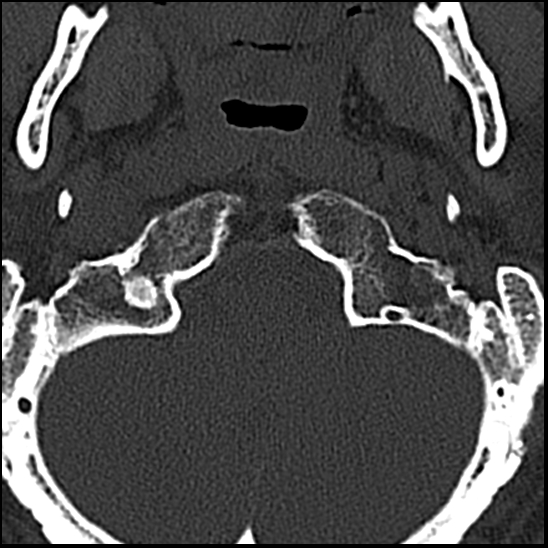 Occipital condyle fracture (type 1) (Radiopaedia 87670-104084 Axial bone window 9).jpg
