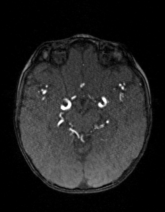 Occipital horn syndrome (Radiopaedia 14255-14129 MRA 71).jpg