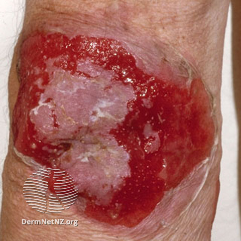 File:Pemphigus vulgaris (DermNet NZ immune-s-pgus9).jpg