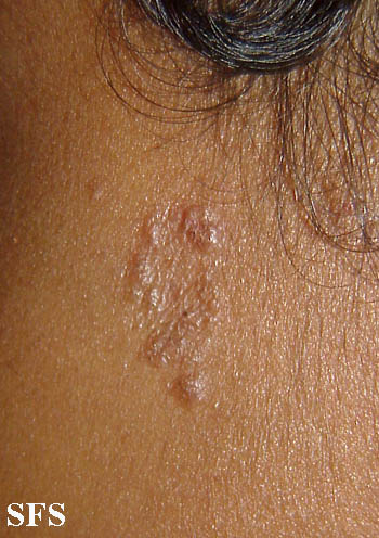 File:Sarcoidosis (Dermatology Atlas 5).jpg