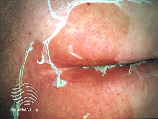 File:Staphylococcal scalded skin syndrome (DermNet NZ ssss).jpg