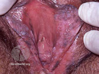 File:Vulval cancer (DermNet NZ site-age-specific-vin2-s).jpg