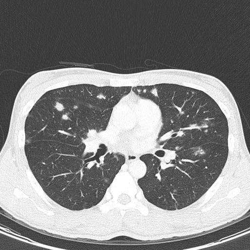 AIDS-related Kaposi sarcoma (Radiopaedia 85247-100811 Axial lung window 82).jpg