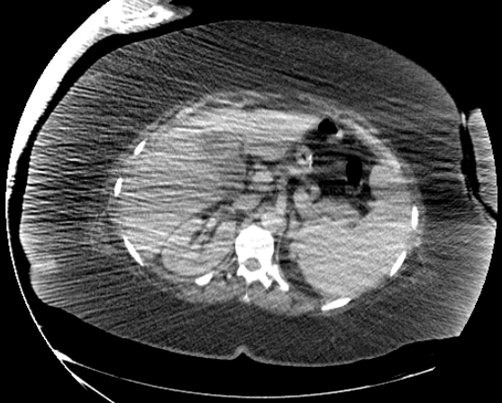 File:Abdominal abscess - pre and post percutaneous drainage (Radiopaedia 60209-67816 Axial 71).png