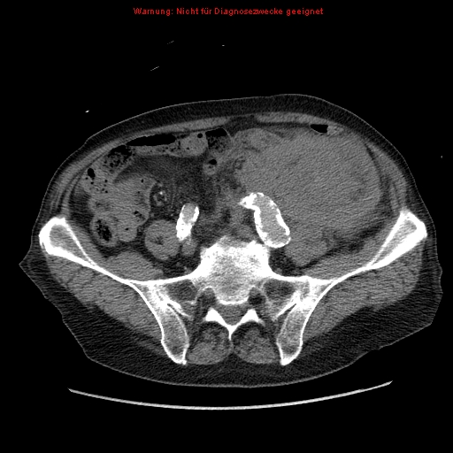File:Abdominal aortic aneurysm- extremely large, ruptured (Radiopaedia 19882-19921 Axial C+ arterial phase 55).jpg