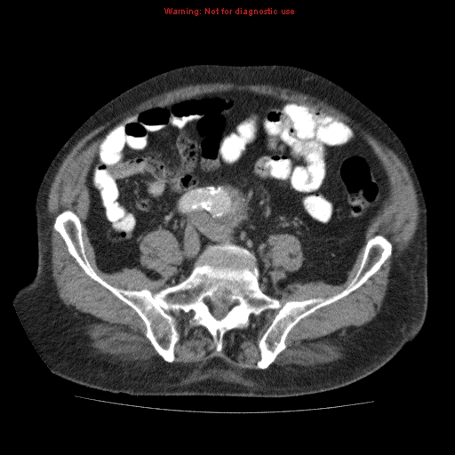Abdominal aortic aneurysm (Radiopaedia 10122-10660 Axial C+ portal venous phase 55).jpg