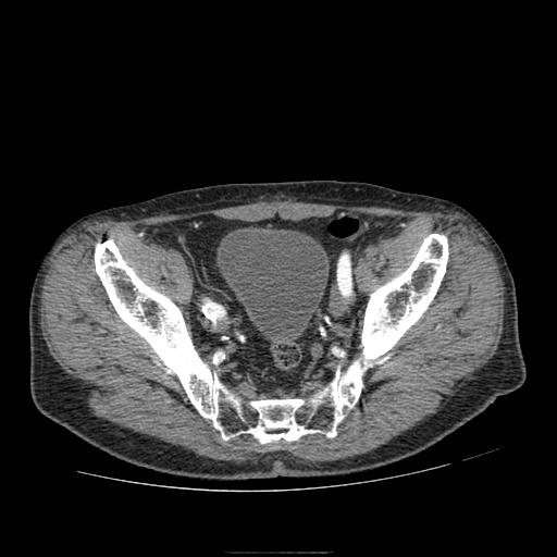 Abdominal aortic aneurysm (Radiopaedia 13341-13340 Axial C+ arterial phase 214).jpg
