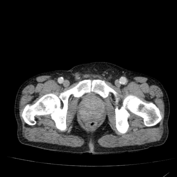 Abdominal aortic aneurysm (Radiopaedia 29248-29660 Axial C+ portal venous phase 62).jpg