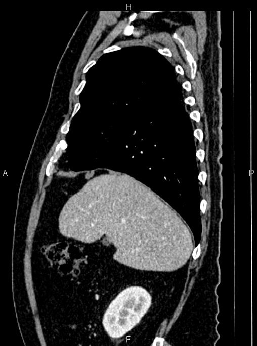 Abdominal aortic aneurysm (Radiopaedia 83094-97462 Sagittal renal cortical phase 33).jpg