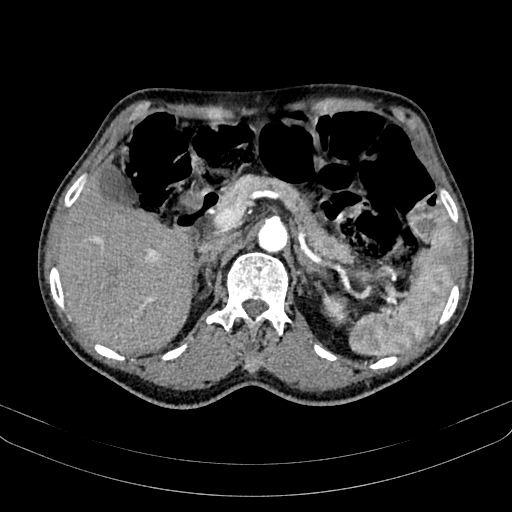 Abdominal aortic aneurysm (Radiopaedia 83581-98689 Axial C+ arterial phase 39).jpg