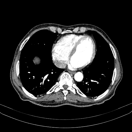 Abdominal aortic aneurysm (Radiopaedia 83581-98689 Axial C+ arterial phase 8).jpg