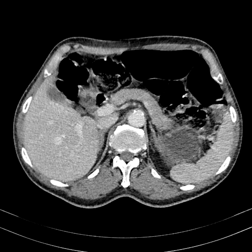 Abdominal aortic aneurysm (Radiopaedia 83581-98689 Axial C+ portal venous phase 31).jpg