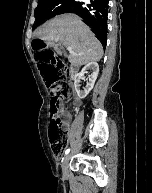 Abdominal aortic aneurysm (Radiopaedia 83581-98689 Sagittal C+ arterial phase 1).jpg