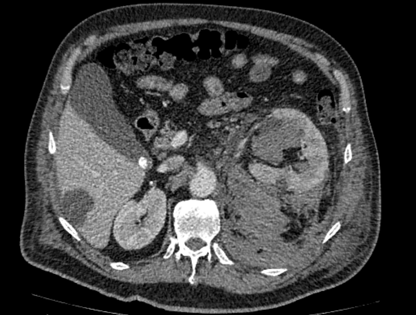 Abdominal aortic aneurysm rupture (Radiopaedia 54179-60362 Axial C+ portal venous phase 27).jpg