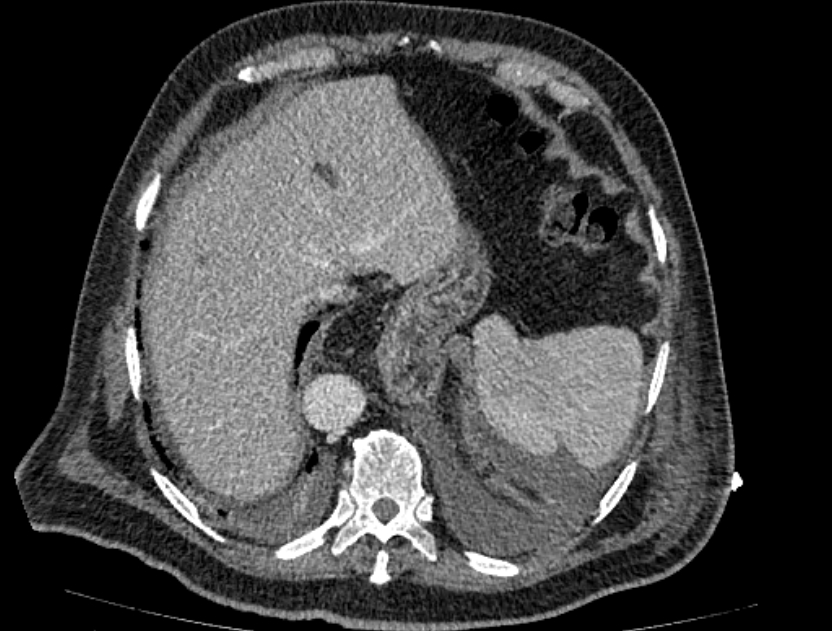 Abdominal aortic aneurysm rupture (Radiopaedia 54179-60362 Axial C+ portal venous phase 34).jpg