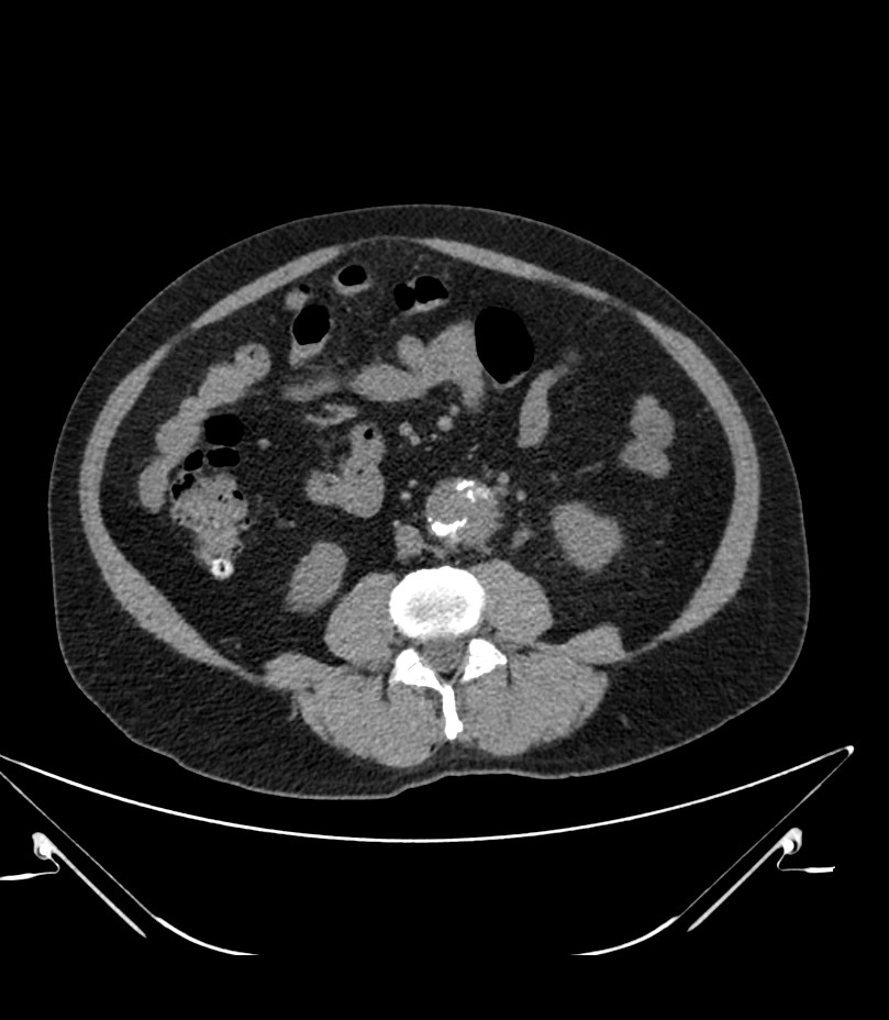 Abdominal aortic aneurysm with thrombus fissuration (Radiopaedia 46218-50618 Axial non-contrast 29).jpg
