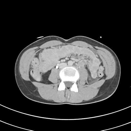 File:Abdominal multi-trauma - devascularised kidney and liver, spleen and pancreatic lacerations (Radiopaedia 34984-36486 Axial C+ delayed 43).png